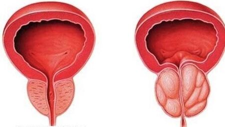 normal and inflammation of the prostate
